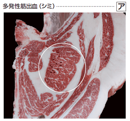 胸最長筋の多発性筋出血